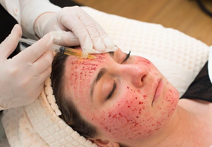 The Centers for Disease Control and Prevention (CDC) , USA  has released a report indicating that three women may have contracted HIV after receiving "vampire facials" at an unlicensed spa in New Mexico. This trendy procedure gained popularity several years ago, notably endorsed by Kim Kardashian. The vampire facial involves drawing blood from the arm, processing it to separate platelets, and reinjecting the platelet-rich plasma into the skin. According to the American Academy of Dermatology Association, the aim of this procedure is to rejuvenate the skin and improve its appearance. The CDC's investigation began when a woman in her 40s tested positive for HIV in 2018 while traveling abroad. She reported no other risk factors for HIV transmission apart from exposure to needles during a platelet-rich plasma (PRP) microneedling procedure at the New Mexico spa in spring 2018. Another individual tested positive for HIV during routine life insurance tests in 2018, and a third woman discovered her HIV status last year when hospitalized with an "AIDS-defining illness."  If confirmed, these cases would represent the first known instances of HIV transmission via a non-sterile cosmetic injection procedure, according to the CDC. The agency underscores the critical importance of adhering to proper infection control practices in all cosmetic procedures to prevent such incidents in the future.