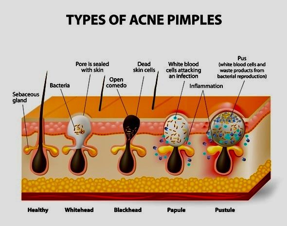 Acne & Pimples – Understanding the Basics 