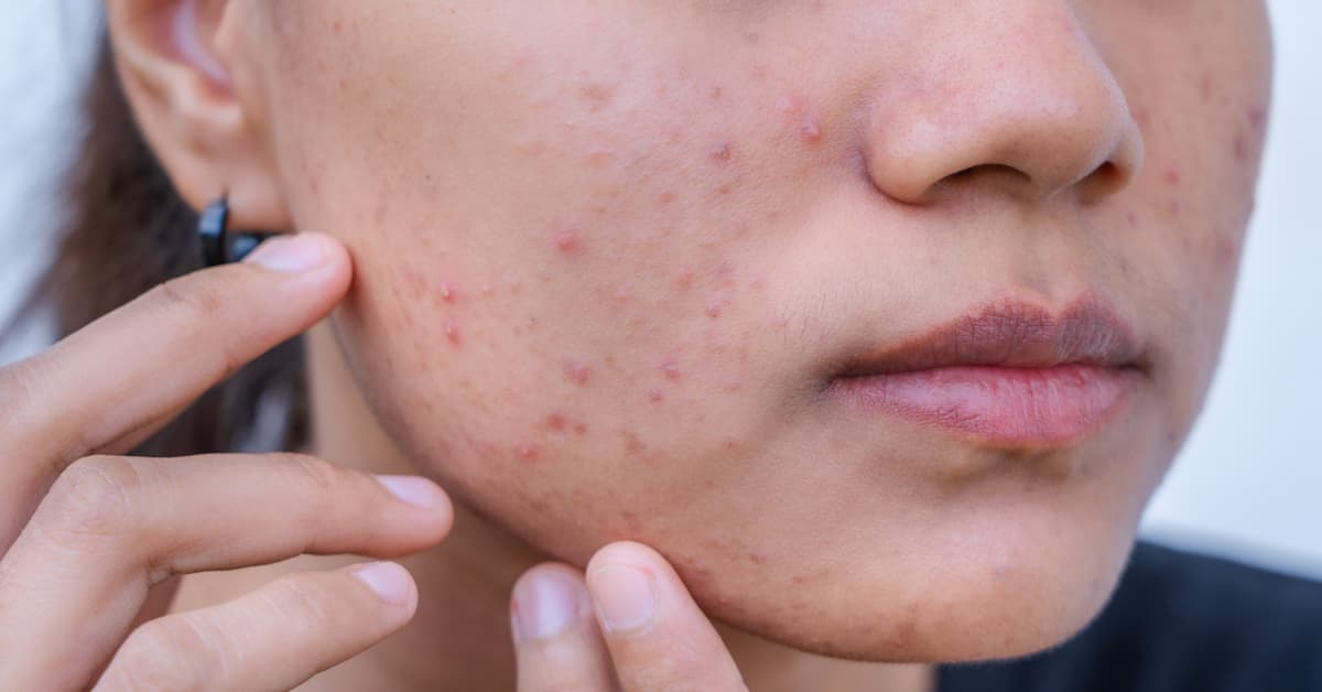 Acne & Pimples – Understanding the Basics 