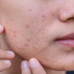 Acne & Pimples – Understanding the Basics