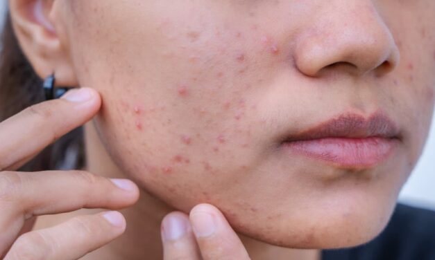 Acne & Pimples – Understanding the Basics